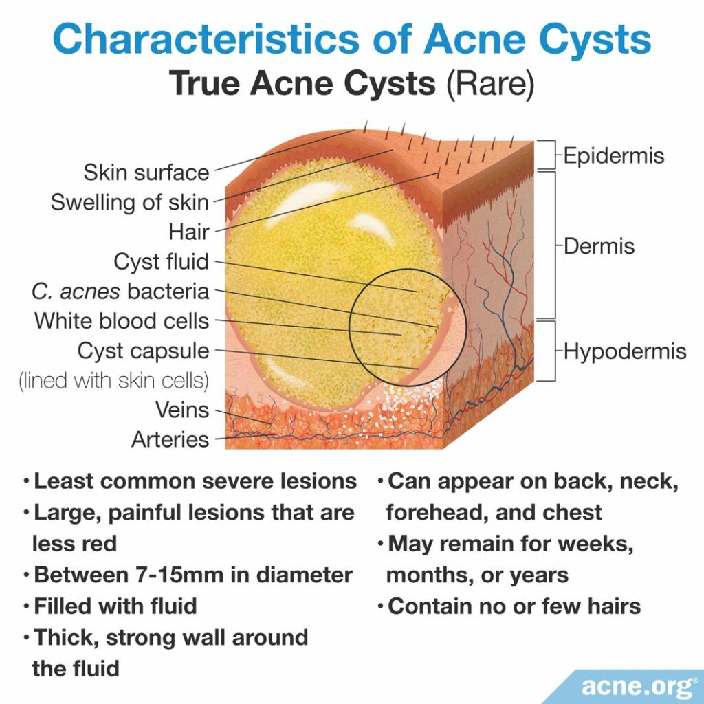 Characteristics of Acne Cysts