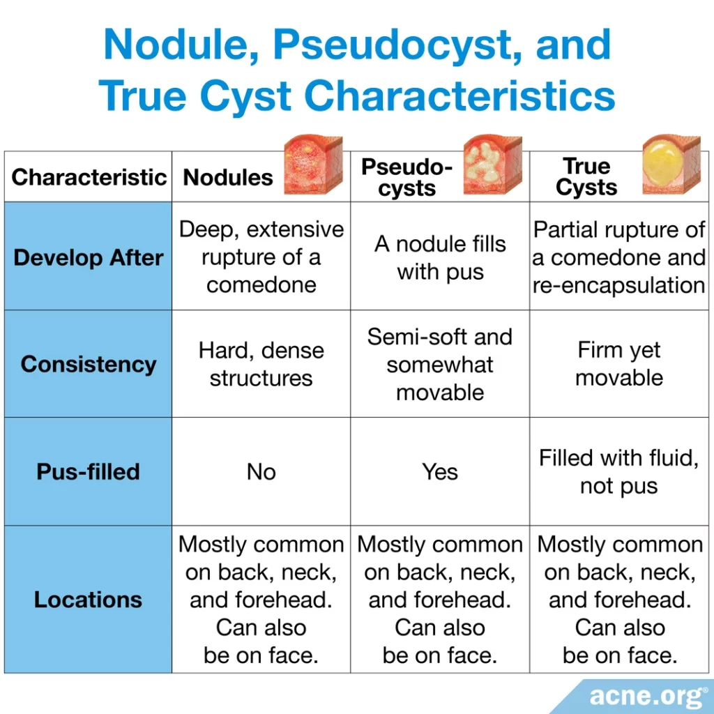 Nodule and True Cyst Characteristics