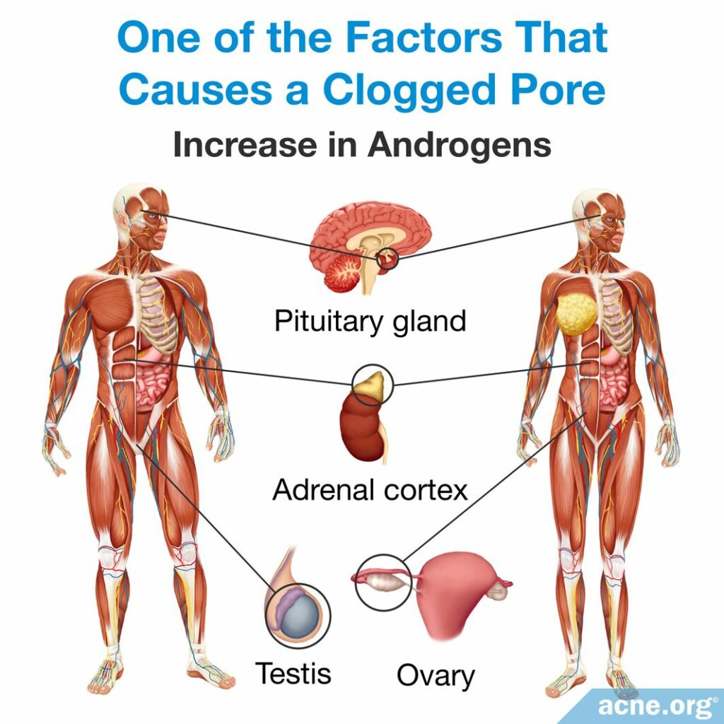Increase in Androgens Causes a Clogged Pore