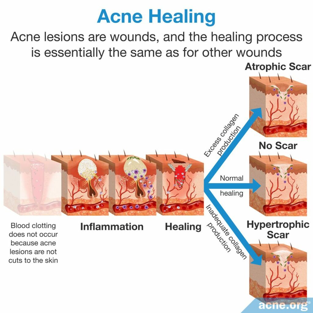 Acne Healing