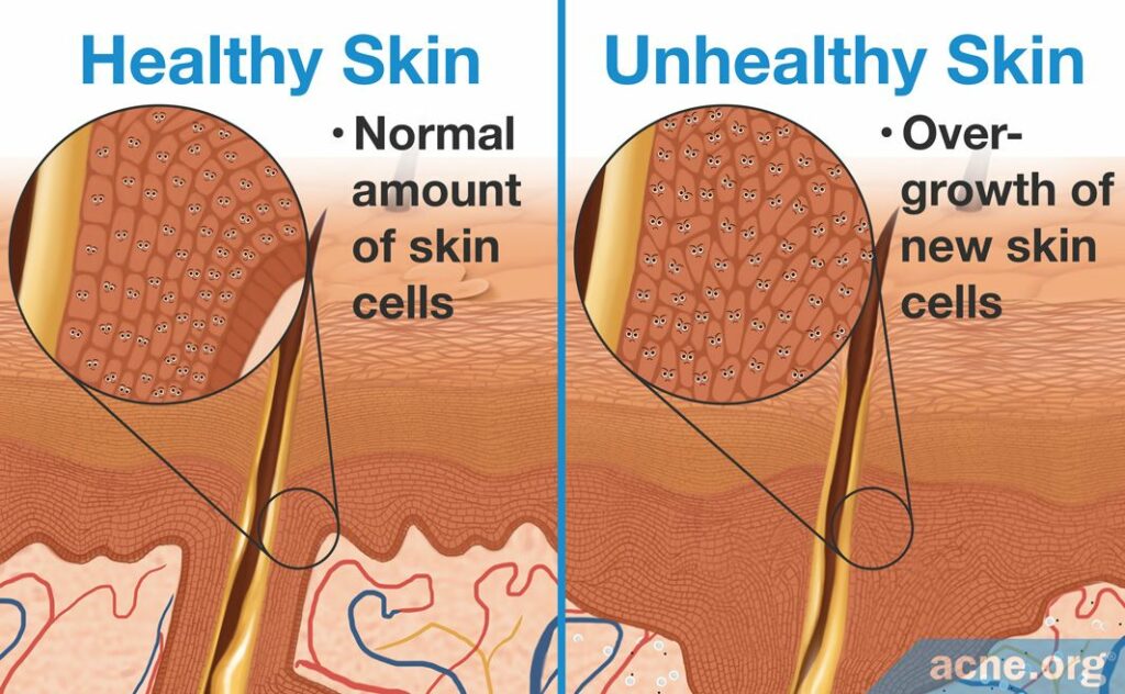 Healthy Skin with Normal Amount of Skin Cells Vs Unhealthy Skin with Overgrowth of New Skin Cells