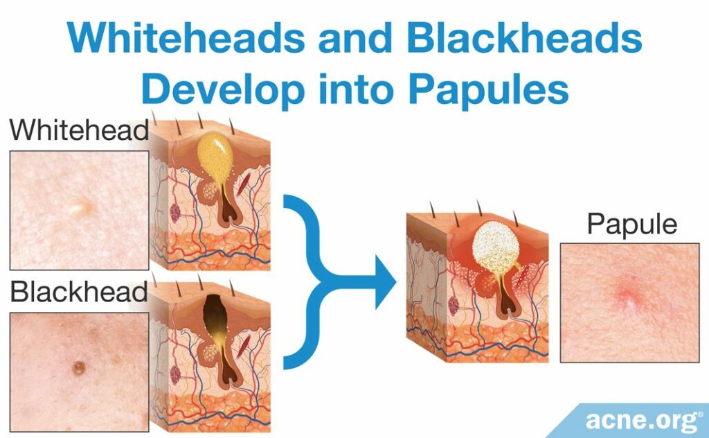Whiteheads and Blackheads Develop into Papules