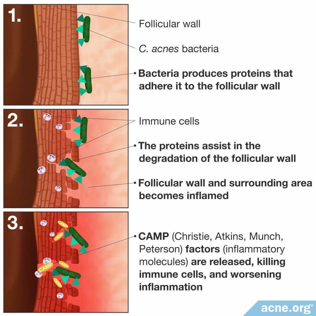 Role of P. acnes in Acne Development
