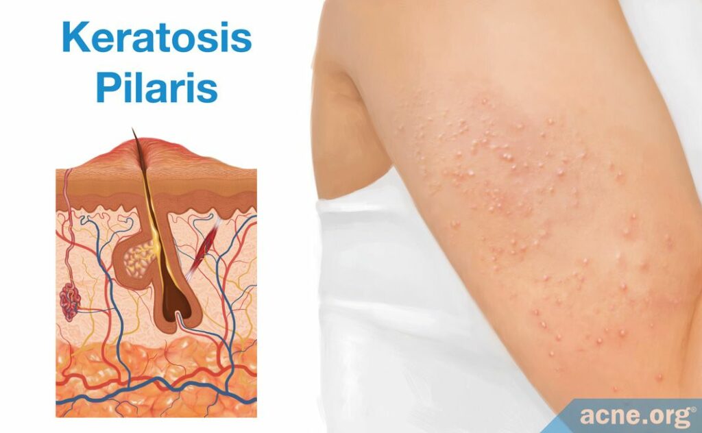 Keratosis Pilaris