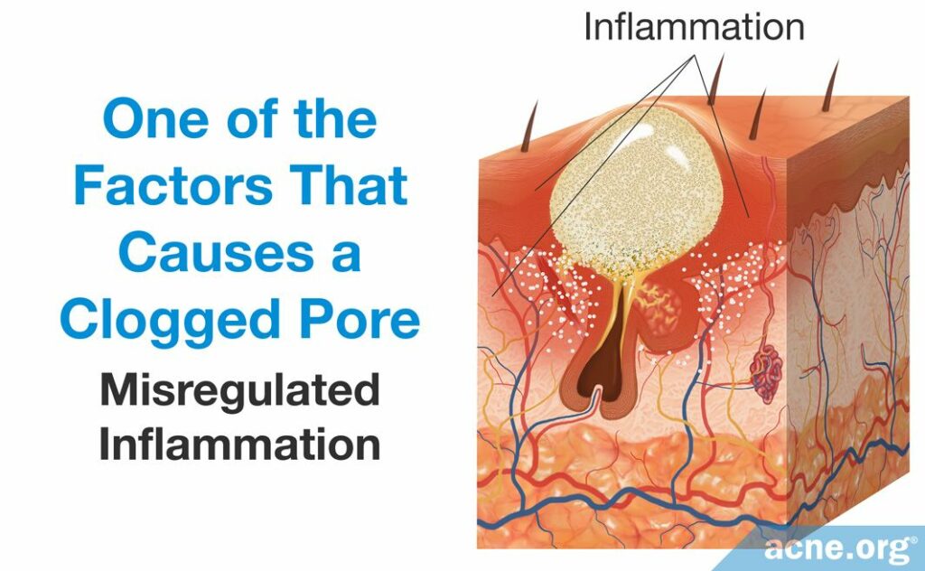 Misregulated Inflammation Cases a Clogged Pore