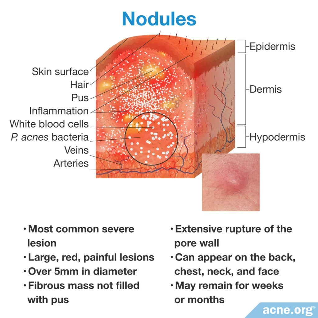 Nodules