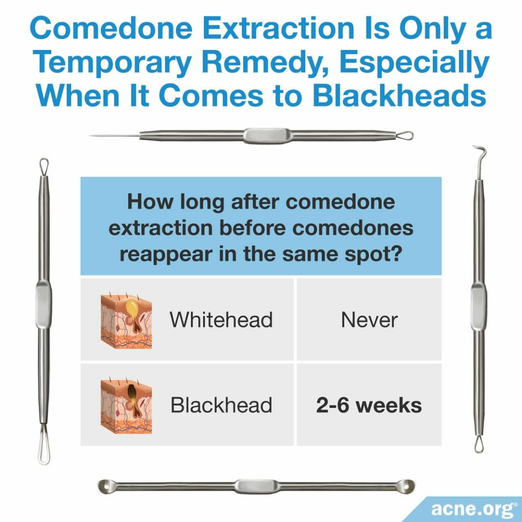 Comedone Extraction is Only a Temporary Remedy, Especially When It Comes to Blackheads