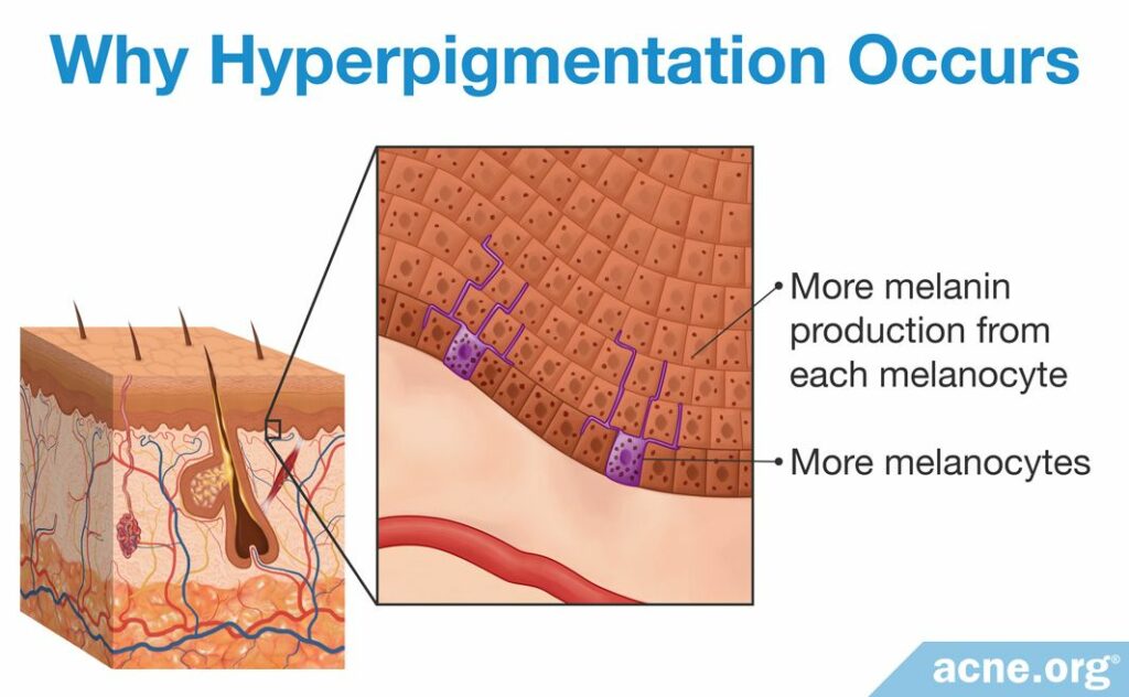 Why Hyperpigmentation Occurs