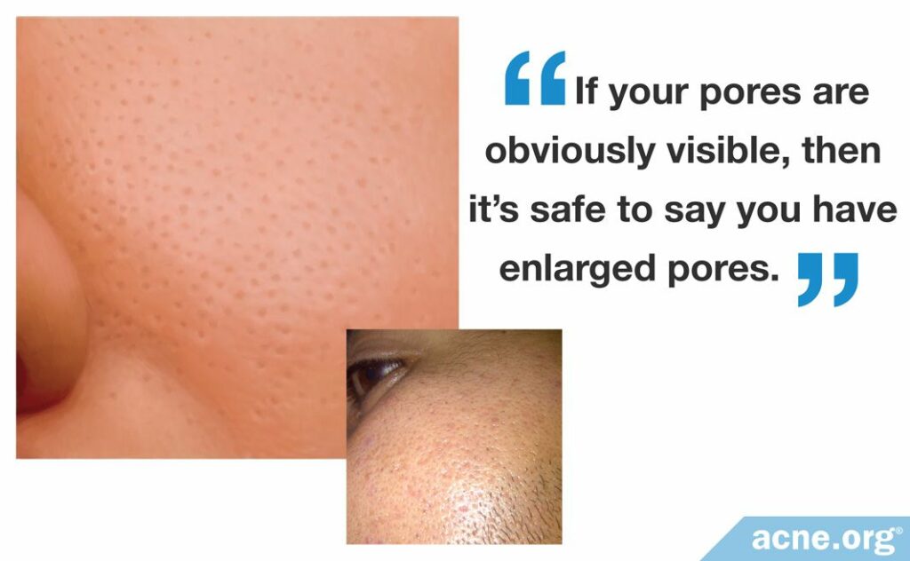 If your pores are obviously visible, then it's safe to say you have enlarged pores (new with photo)