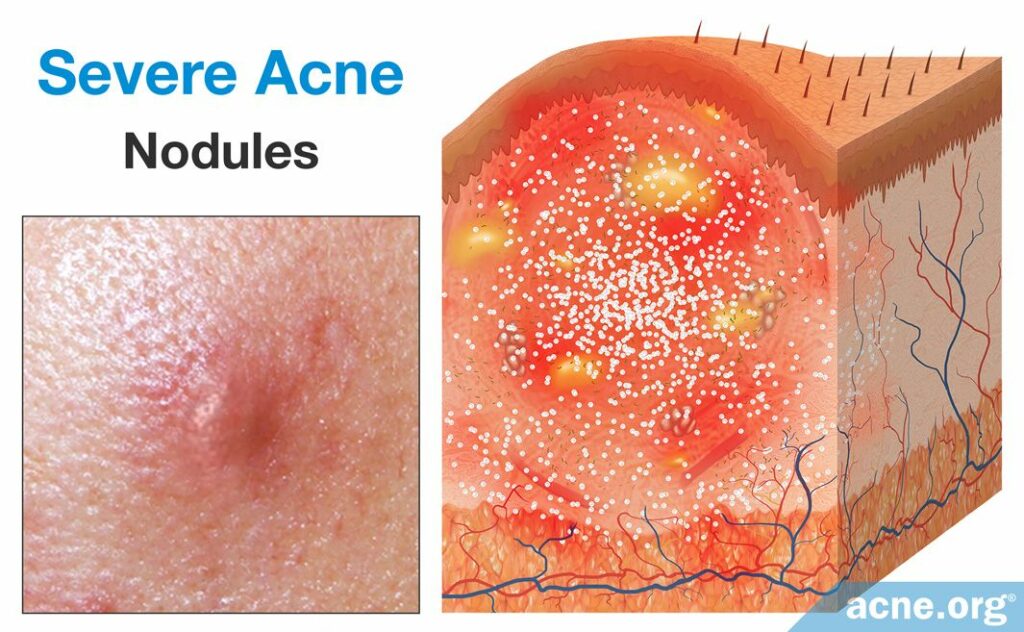 Severe Acne Nodules