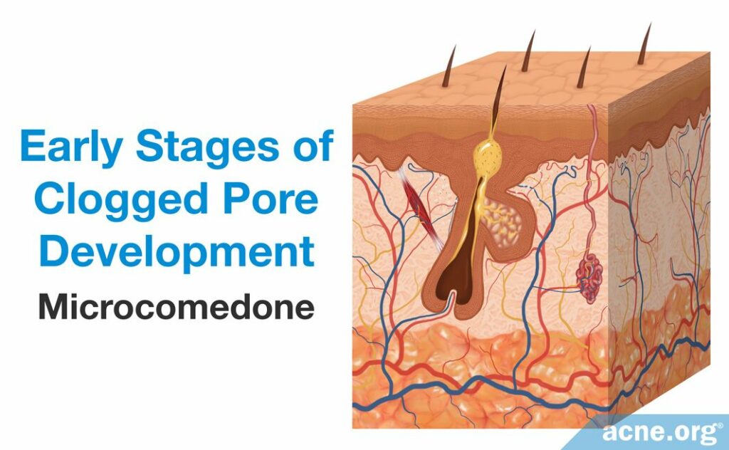 Early Stages of Clogged Pore Development Microcomedone