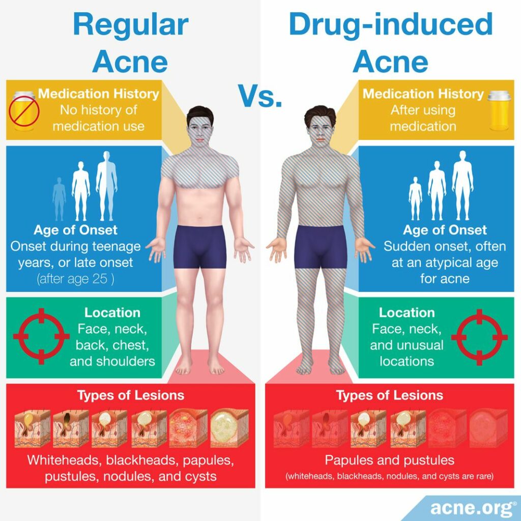 Regular Acne Vs. Drug-induced Acne