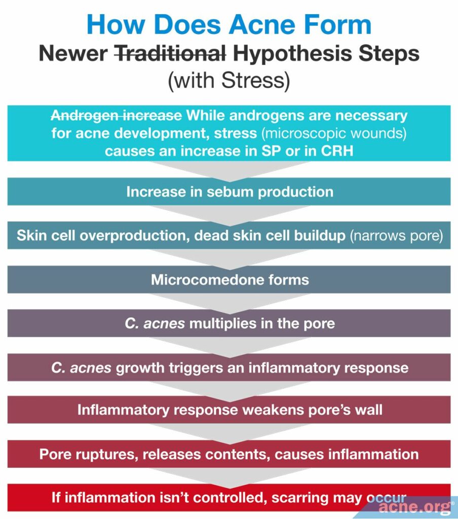 How Does Acne Form Newer Hypothesis Steps with Stress