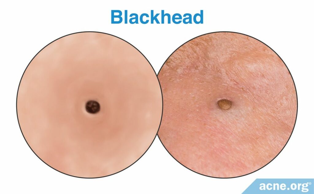 Blackhead