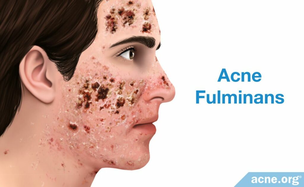 Acne Fulminans