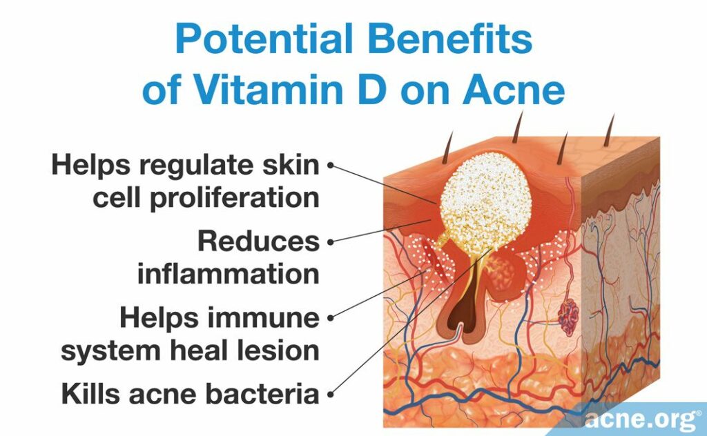 Potential Benefits of Vitamin D on Acne