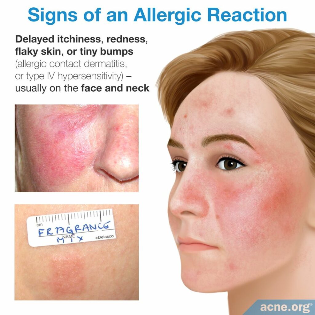 Signs of an Allergic Reaction