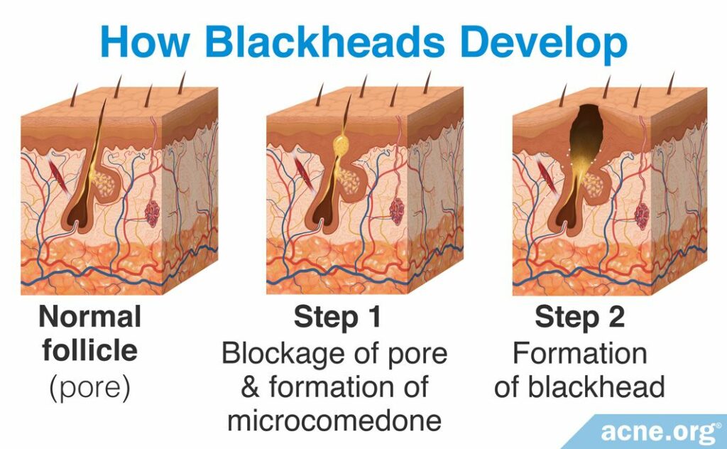 How Blackheads Develop