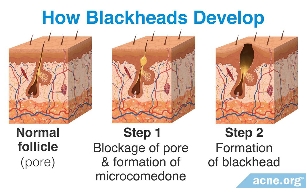 What Is a Blackhead? - Acne.org
