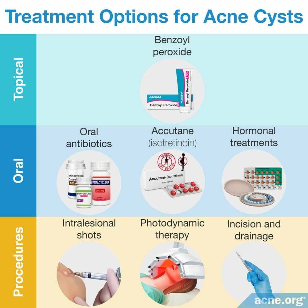 Treatment Options for Acne Cysts