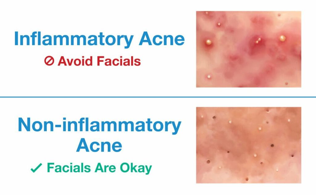 Avoid Facials for Inflammatory Acne but Facials Are Okay for Non-inflammatory Acne
