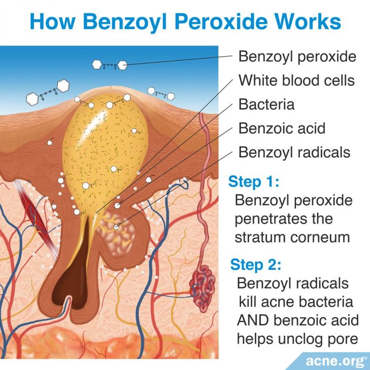 How Benzoyl Peroxide Works