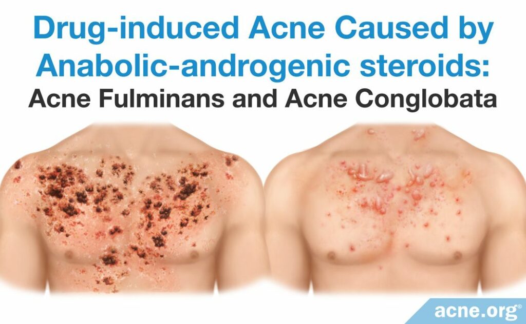 Drug-induced Acne Caused by Anabolic-androgenic Steroids - Acne Fulminans and Acne Conglobata.