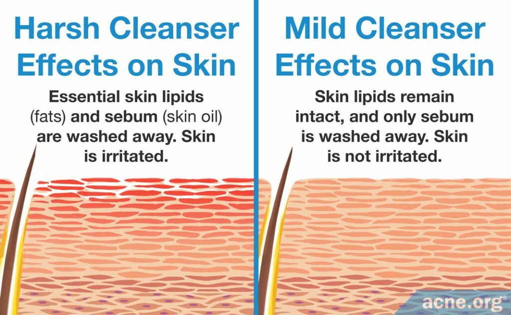 Effects on the Skin of a Harsh Vs Mild Cleanser