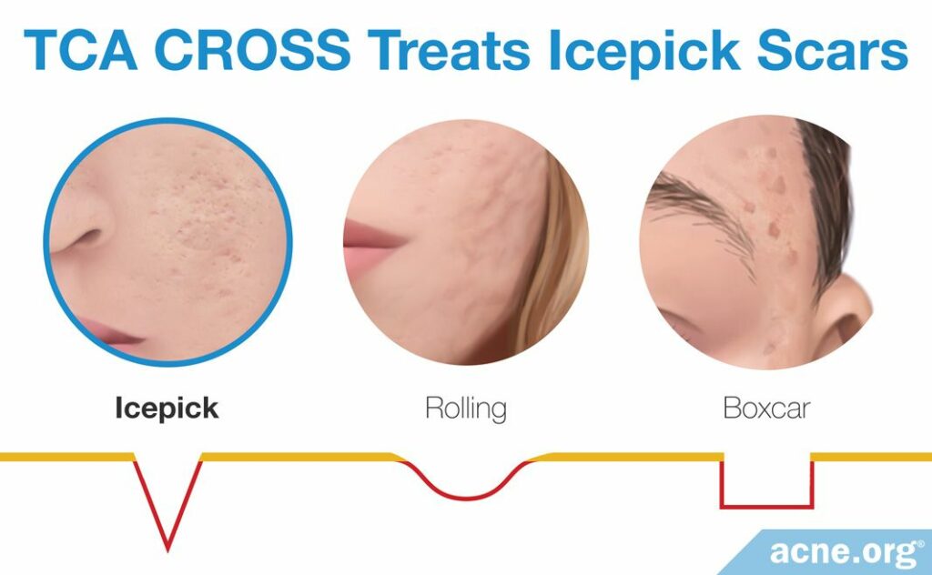 TCA CROSS Treats Icepick Scars