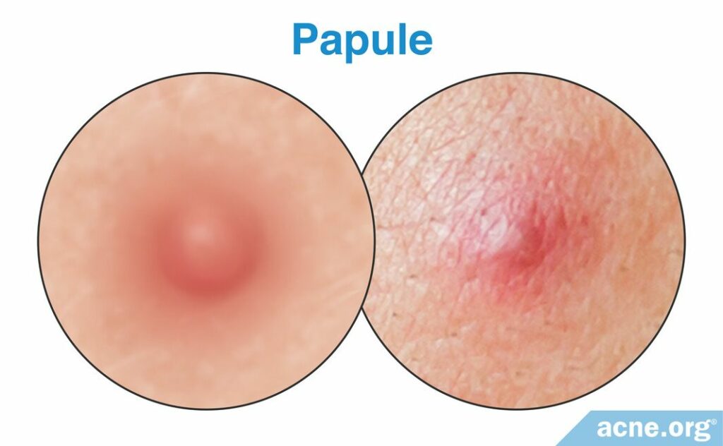 Papule