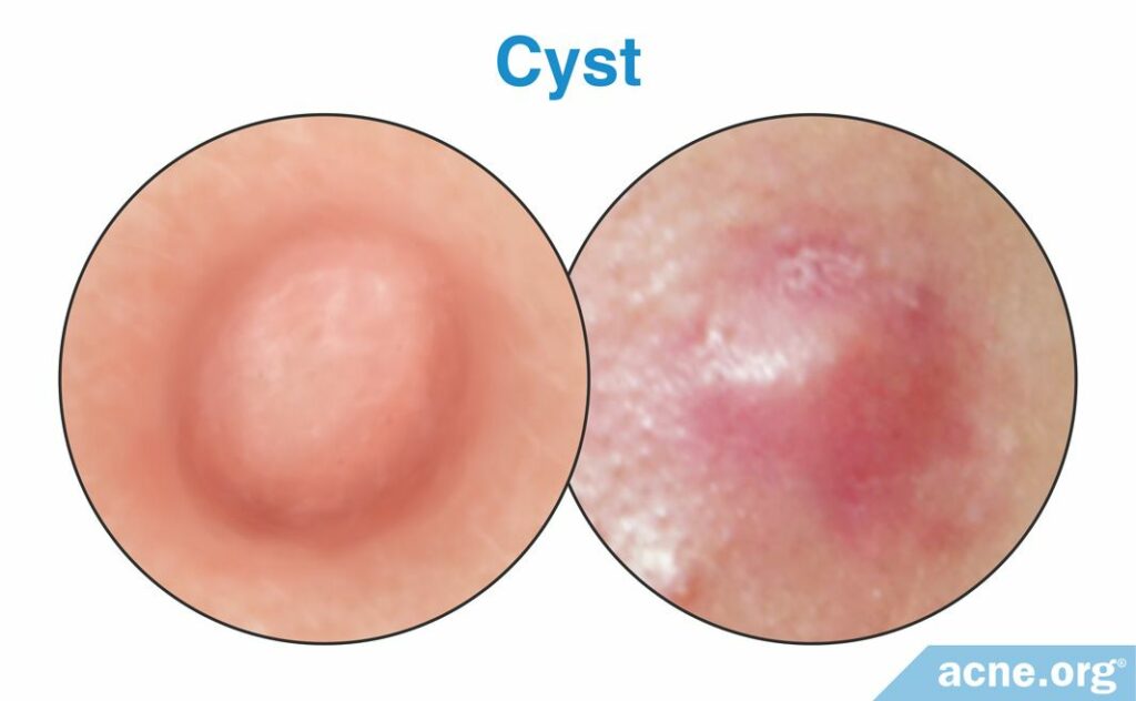 Cyst