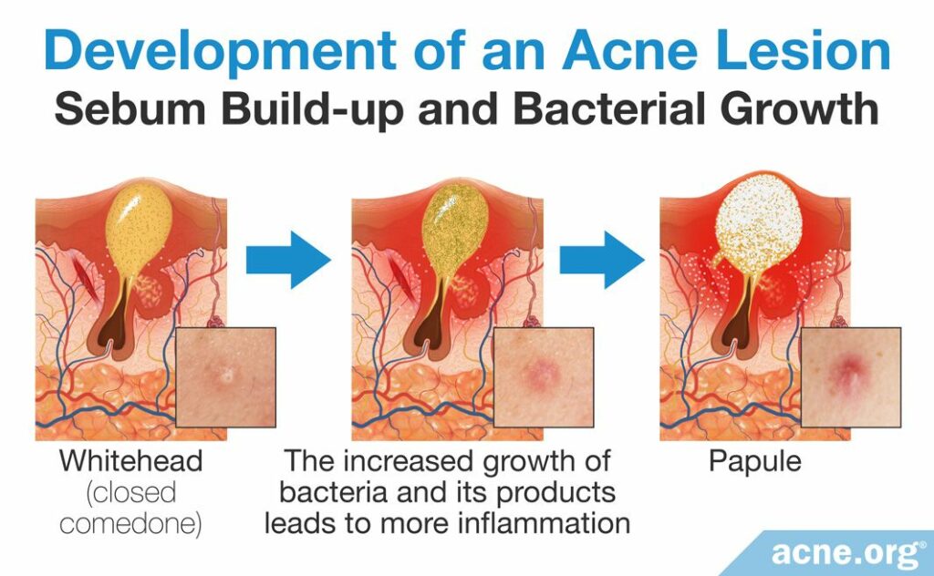 Development of an Acne Lesion Sebum Build-up and Bacterial Growth