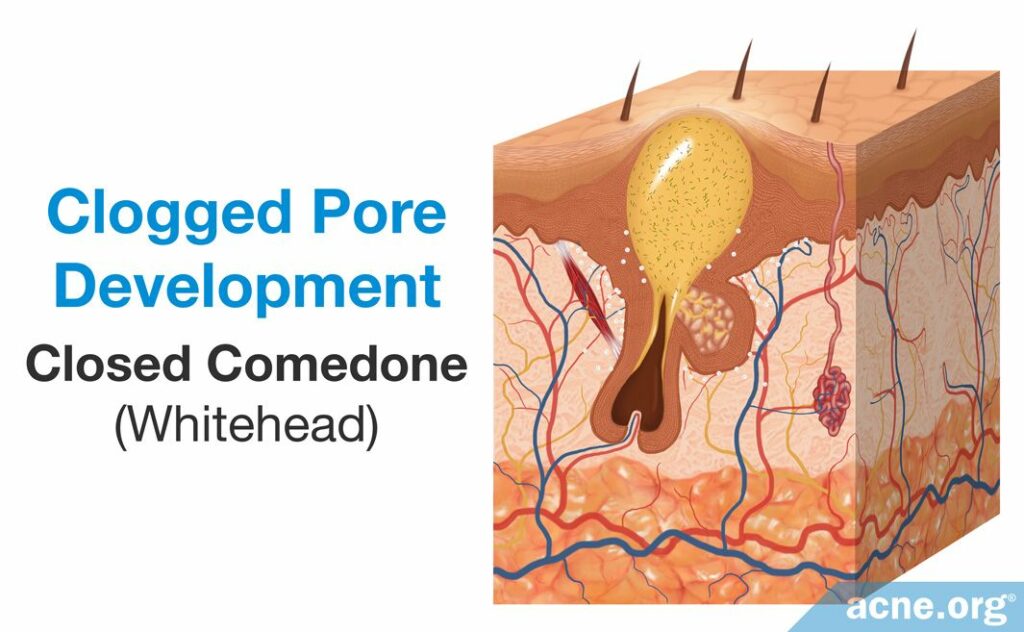 Clogged Pore Development Comedone Whitehead