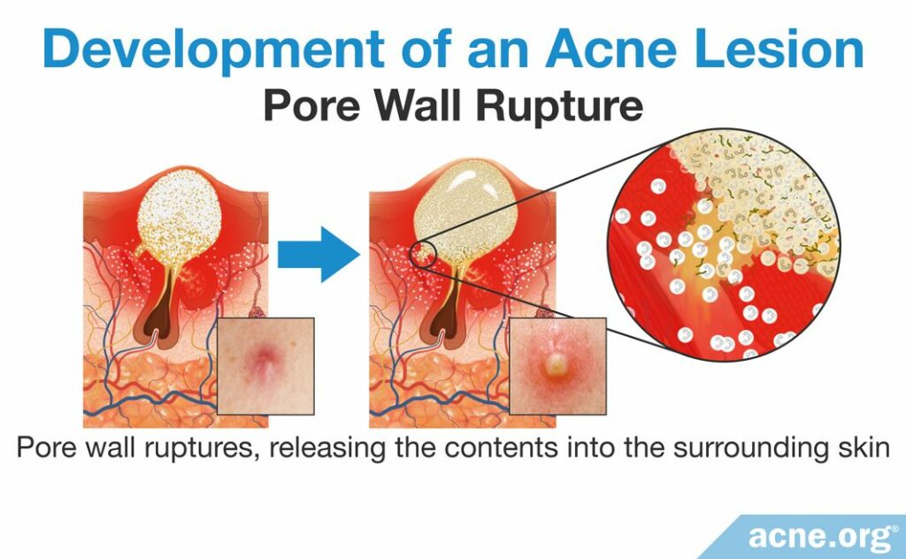 Development of and Acne Lesion Pore Wall Rupture