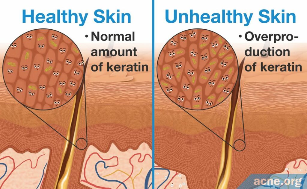 Healthy Skin Normal Amount of Keratin Vs Unhealthy Skin Overproduction of Keratin