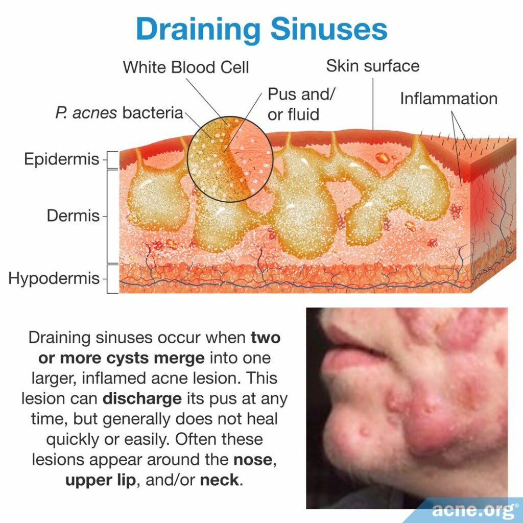 Draining Sinuses