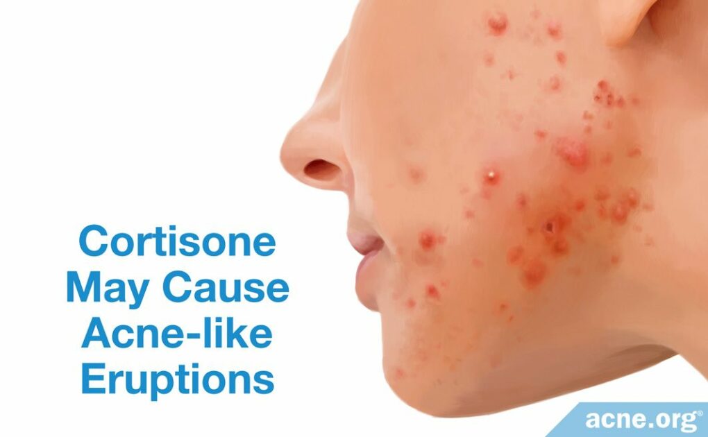 Can Topical Hydrocortisone Help with Acne?