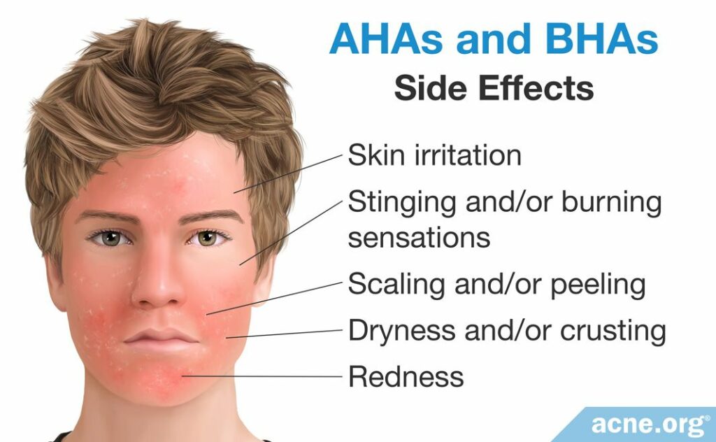 Side Effects of AHAs and BHAs