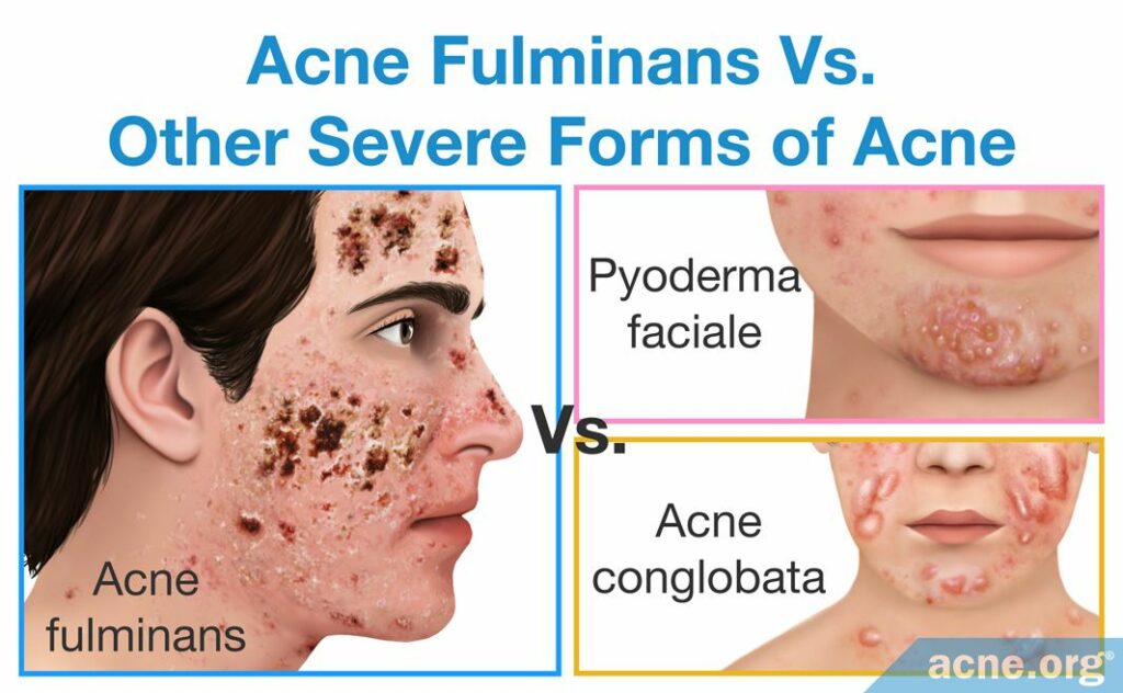 Acne Fulminans Vs. Other Severe Forms of Acne