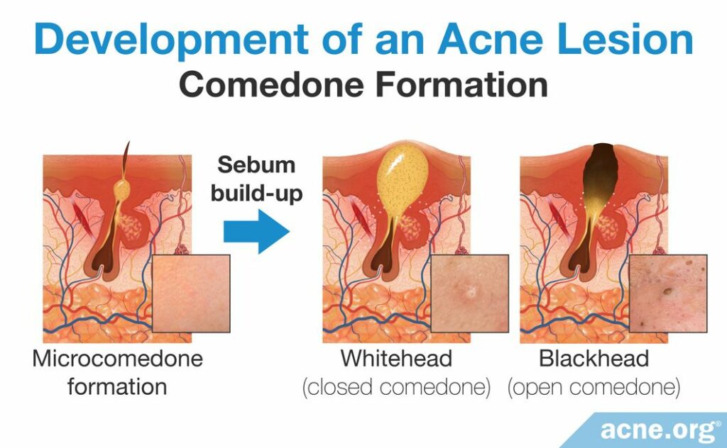 Development of an Acne Lesions Comedone Formation