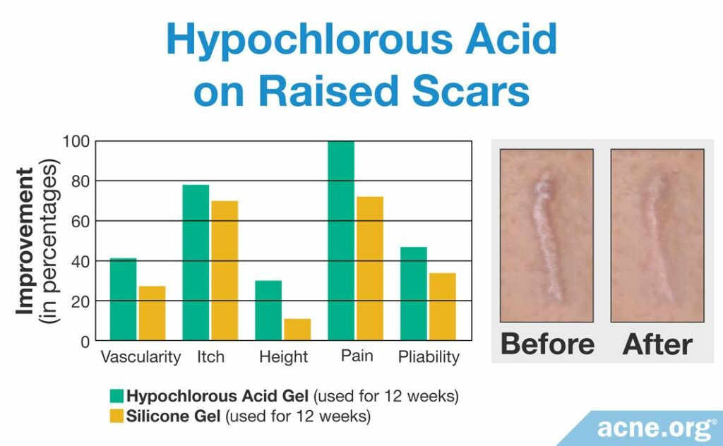 Hypochlorous Acid on Raised Scars