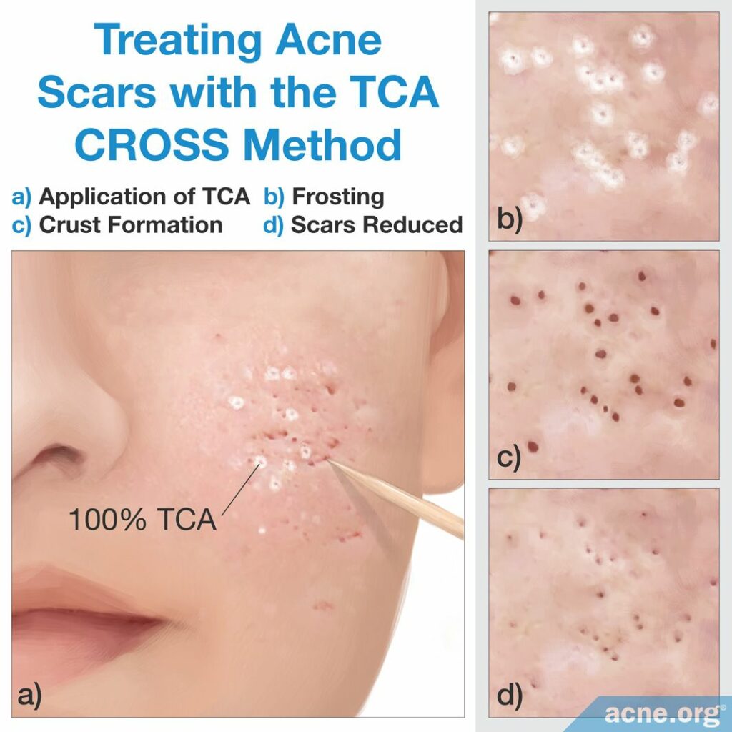 Treating acne scars with the TCA CROSS method