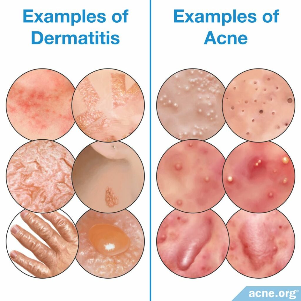 Examples of Dermatitis and Acne