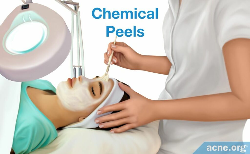 Chemical Peels for Enlarged Pores