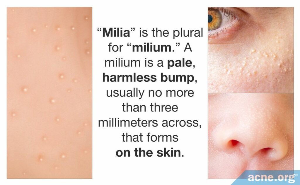 Close-up Graphic of Milia