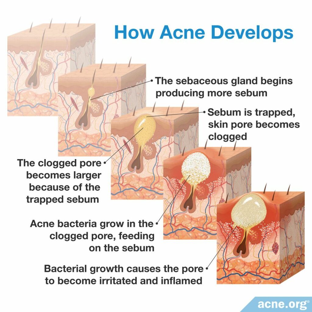 How Acne Develops