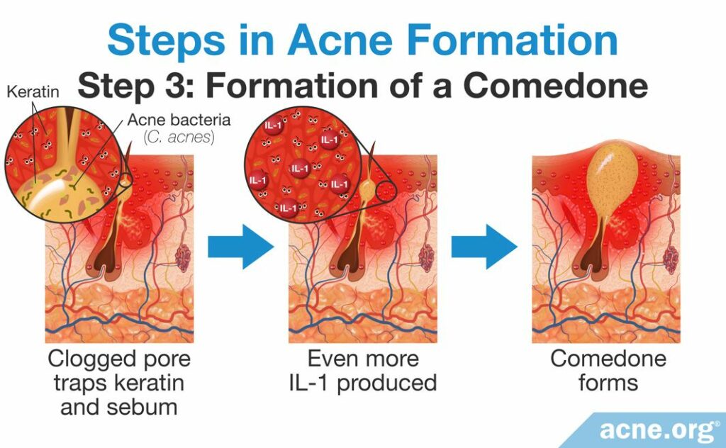 Steps in Acne Formation Step 3 Formation of a Comedone