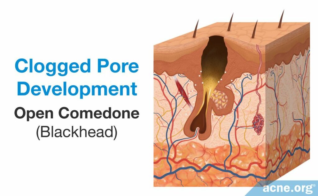 Clogged Pore Development Open Comedone Blackhead