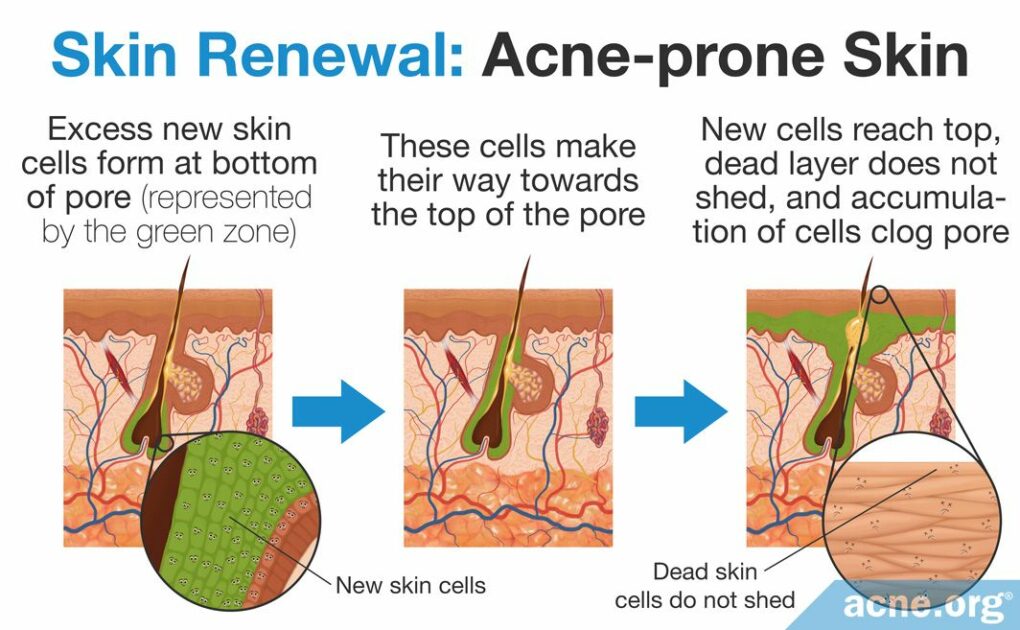 Acne Indepth How Dead Skin Cell Accumulation Can Lead to Acne
