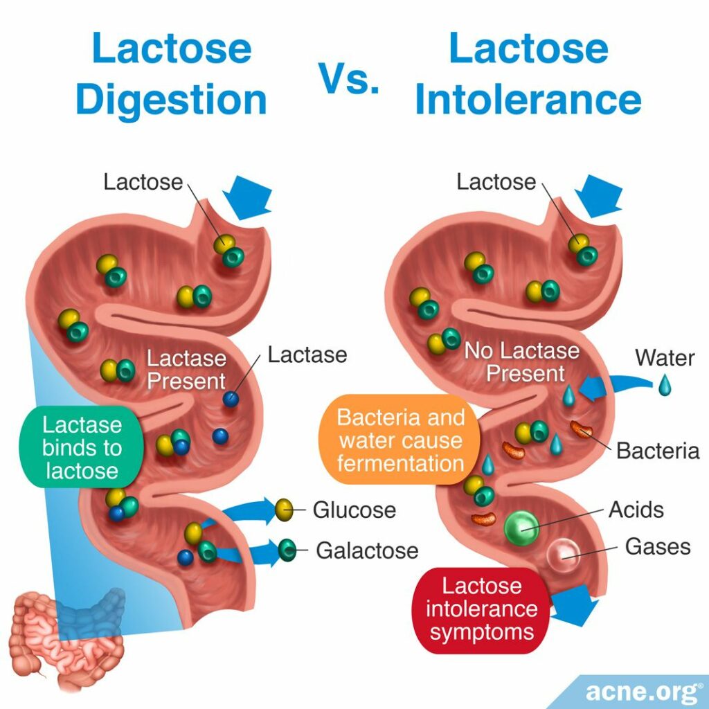 Lactose Digestion Vs. Lactose Intolerance